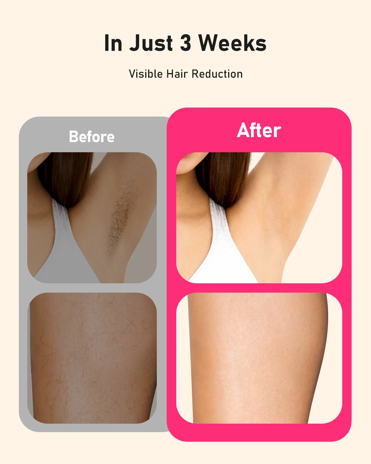 JOOYEE IPL Laser Hair Removal Home Epilator 3 In 1